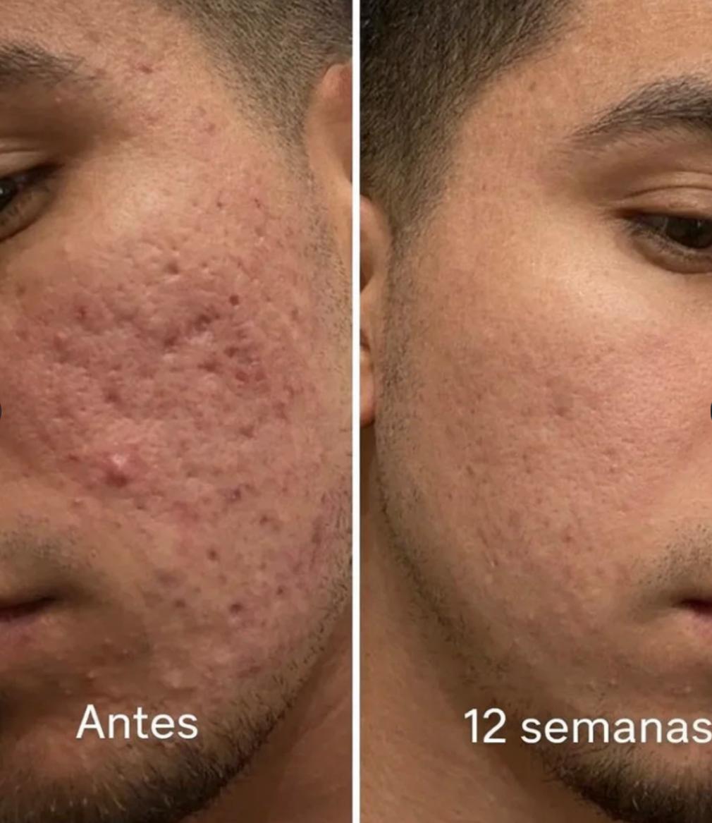 Serum de acné y cicatrices.